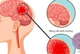 Bệnh não mô cầu có thể gây tử vong nhanh, chuyên gia cảnh báo những dấu hiệu nguy hiểm
