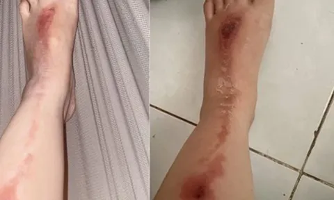 Bị bỏng do pháo hoa bắn trúng người