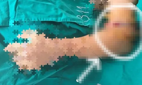 Nối cánh tay đứt rời cho người bệnh bị tai nạn lao động
