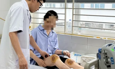 Hoại tử vùng cẳng chân vì chữa bệnh bằng phương pháp dùng ong đốt