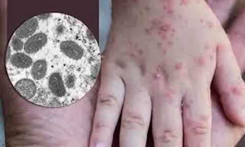 Hà Nội tăng cường biện pháp phòng, chống bệnh đậu mùa khỉ