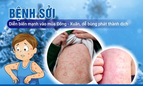 Công điện của Thủ tướng Chính phủ về tăng cường công tác phòng, chống bệnh sởi