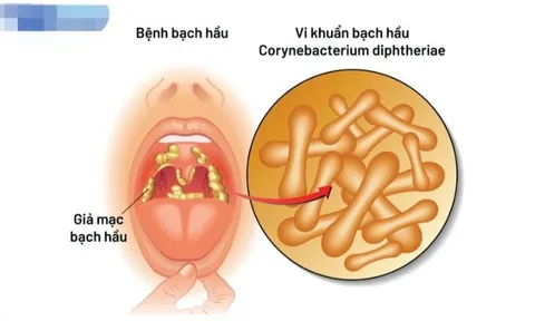 Bộ Y tế yêu cầu xử lý triệt để ổ dịch bạch hầu