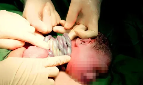Cực hiếm: Bé gái chào đời với 9 vòng dây rốn quấn cổ