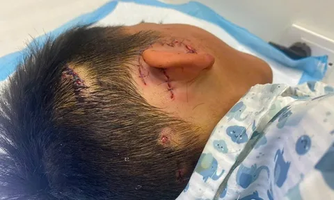 Bé trai ở Hà Nội suýt mất tai vì bị chó nhà cắn