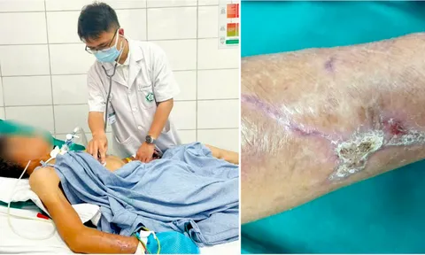 Vết thương do dị vật đâm gây ra uốn ván nặng