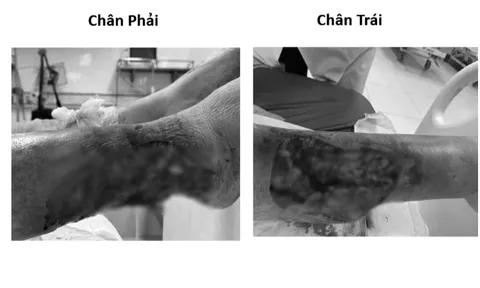 Lóc da cẳng chân ở bệnh nhân tiểu đường: Cảnh báo biến chứng từ những tai nạn tưởng chừng đơn giản