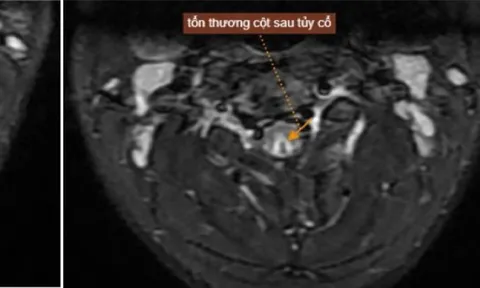 Lạm dụng bóng cười hơn 50 quả mỗi lần, nam thanh niên tổn thương tủy sống