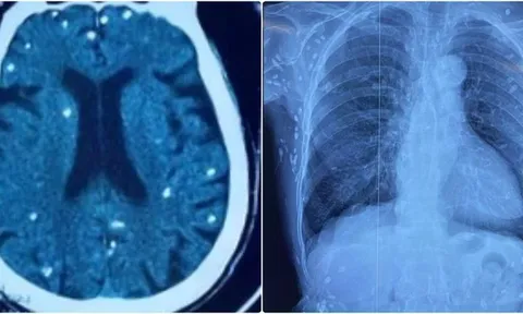 Nang sán dây lợn gây vôi hóa đầy cơ thể