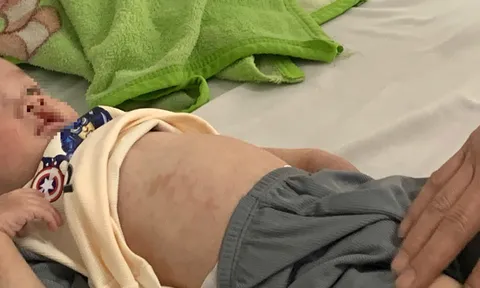 Số ca sốt xuất huyết và tay chân miệng tăng nhiều lần