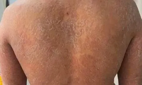 Sai lầm trong điều trị nấm da, bệnh da bùng phát khắp cơ thể
