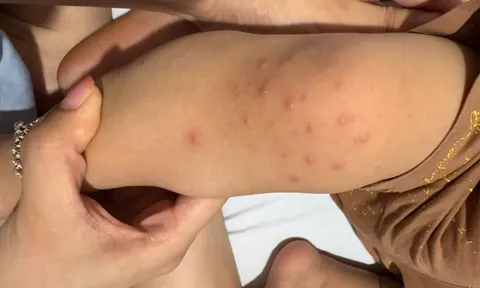 Hà Nội chủ động đẩy lùi bệnh tay chân miệng