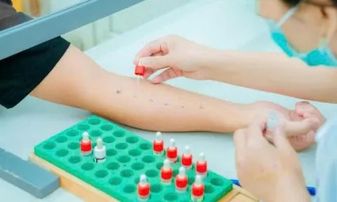 Nguy cơ khó lường từ dị ứng thuốc và thức ăn