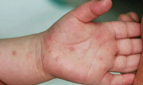 Ghi nhận 3.000 ca mắc tay chân miệng mỗi tuần, Bộ Y tế khuyến cáo khẩn