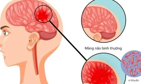 Bệnh não mô cầu có thể gây tử vong nhanh, chuyên gia cảnh báo những dấu hiệu nguy hiểm