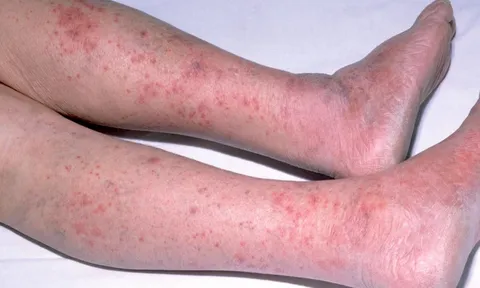 Sự nguy hiểm của viêm màng não do não mô cầu nhóm B