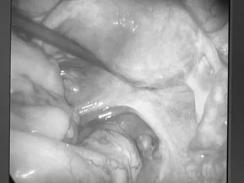 Xử trí kịp thời cho ca chửa ngoài tử cung trước và sau phúc mạc hiếm gặp