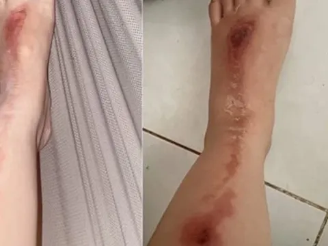 Bị bỏng do pháo hoa bắn trúng người