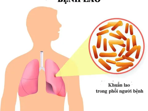Thủ tướng chỉ đạo tăng cường công tác phòng, chống bệnh Lao