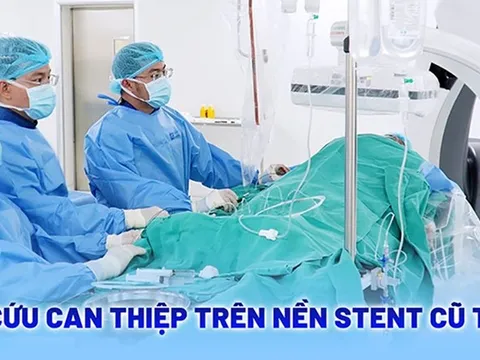 Khoan lòng mạch và đặt stent cứu sống bệnh nhân tái hẹp mạch vành nặng