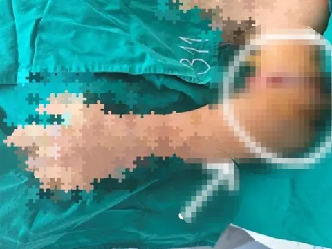Nối cánh tay đứt rời cho người bệnh bị tai nạn lao động