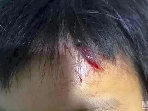 Khởi tố vụ án bé trai bị bạo hành tại Cà Mau