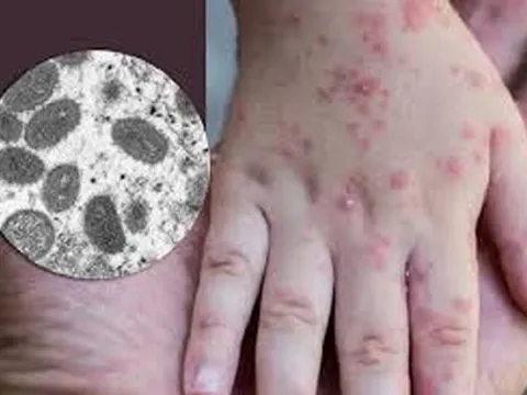 Hà Nội tăng cường biện pháp phòng, chống bệnh đậu mùa khỉ