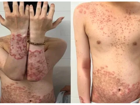 Tự điều trị thuốc không rõ nguồn gốc, người bệnh nhiễm nấm lan tỏa toàn thân
