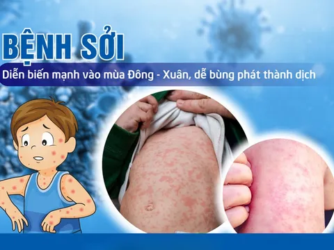Công điện của Thủ tướng Chính phủ về tăng cường công tác phòng, chống bệnh sởi