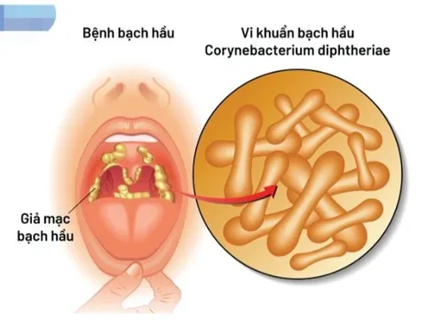 Bộ Y tế yêu cầu xử lý triệt để ổ dịch bạch hầu