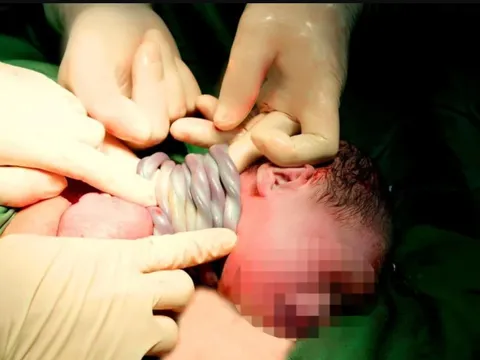 Cực hiếm: Bé gái chào đời với 9 vòng dây rốn quấn cổ