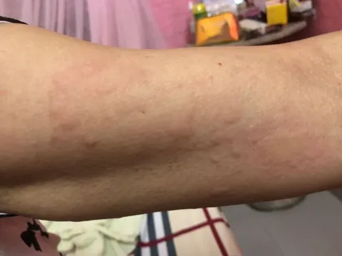 Phòng ngừa mày đay bùng phát vào mùa đông
