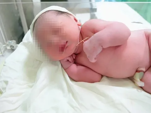 Bé gái chào đời cùng vòng tránh thai của mẹ