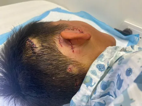 Bé trai ở Hà Nội suýt mất tai vì bị chó nhà cắn