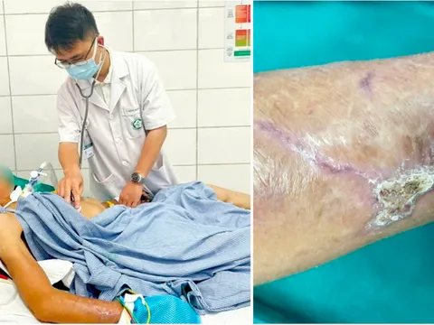Vết thương do dị vật đâm gây ra uốn ván nặng