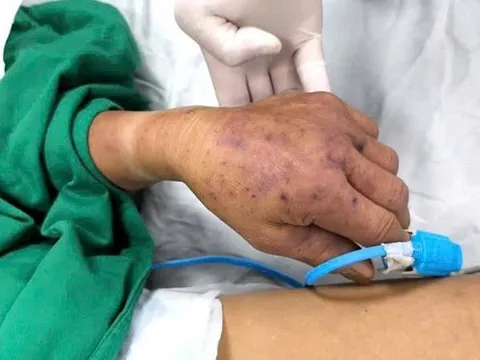 Cấp cứu bệnh nhân bị sốc nhiễm khuẩn sau khi ăn tiết canh, lòng lợn