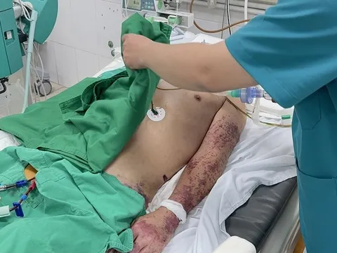 6 khuyến cáo của Bộ Y tế về phòng, chống bệnh liên cầu lợn ở người