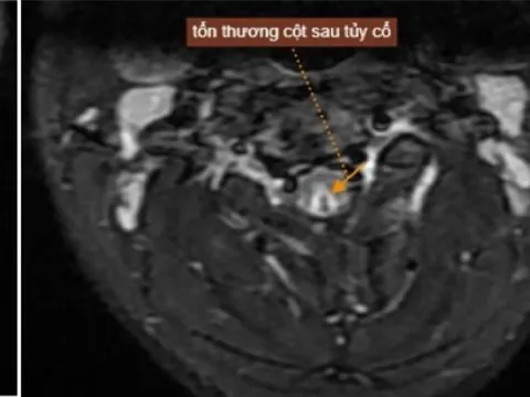 Lạm dụng bóng cười hơn 50 quả mỗi lần, nam thanh niên tổn thương tủy sống
