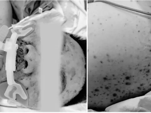 Suy đa phủ tạng do chủ quan bỏ qua tiêm phòng thủy đậu