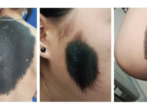 Nơ vi hắc tố bẩm sinh không đơn thuần là “vết bớt” vô hại