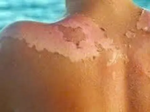Bảo vệ làn da trước thời tiết nắng nóng cực đoan