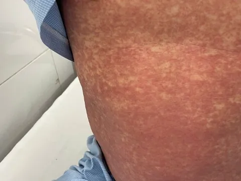 Bộ Y tế cảnh báo tuyệt đối không mua, bán hoặc sử dụng các thuốc chứa Phenylbutazone
