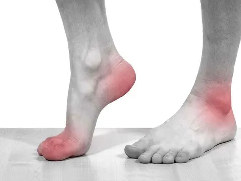 Gia tăng người trẻ đau khớp do gout, bác sĩ cảnh báo dấu hiệu cần chú ý