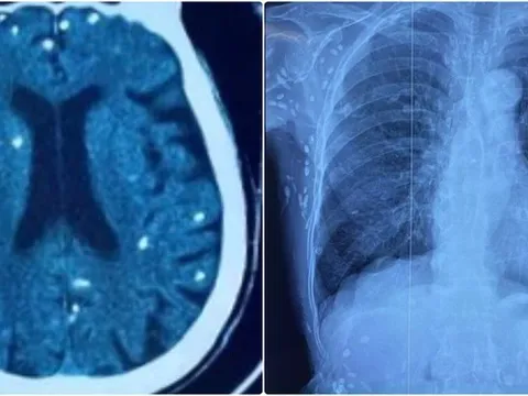 Nang sán dây lợn gây vôi hóa đầy cơ thể