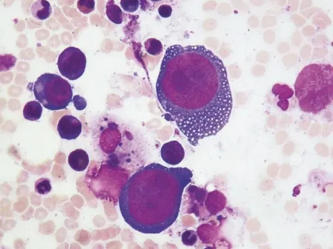 Ghi nhận ca viêm não cấp hiếm gặp do Parvovirus B19 ở Việt Nam