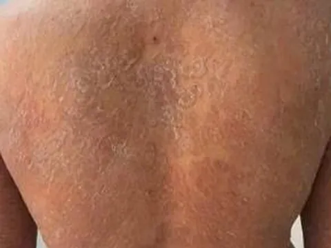 Sai lầm trong điều trị nấm da, bệnh da bùng phát khắp cơ thể
