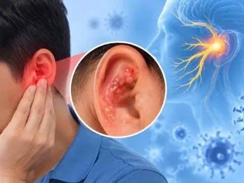 Liệt mặt sau đau quanh tai, nổi mụn nước: Cẩn trọng với Ramsay Hunt