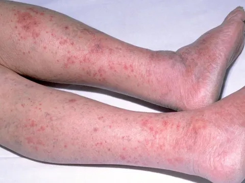 Sự nguy hiểm của viêm màng não do não mô cầu nhóm B