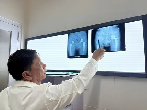 Phát hiện kịp thời và thay khớp háng thành công cho người bệnh bị hoại tử chỏm xương đùi